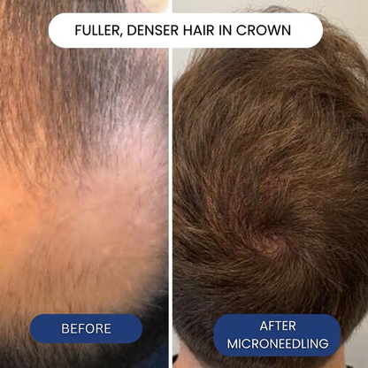 Revival Hair Regrowth Infusion™ System